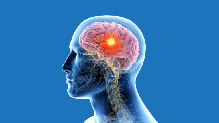 How serious is a brain tumor