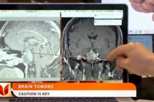 Brain Tumors program still featuring Dr. George Kaptain
