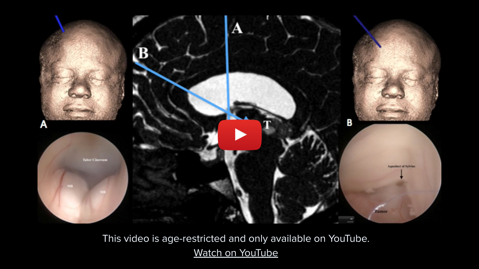 New Jersey Brain and Spine | Endoscopic Biopsy and Resection of Intraventricular Tumors New Jersey Brain and Spine | Endoscopic Biopsy and Resection of Intraventricular Tumors