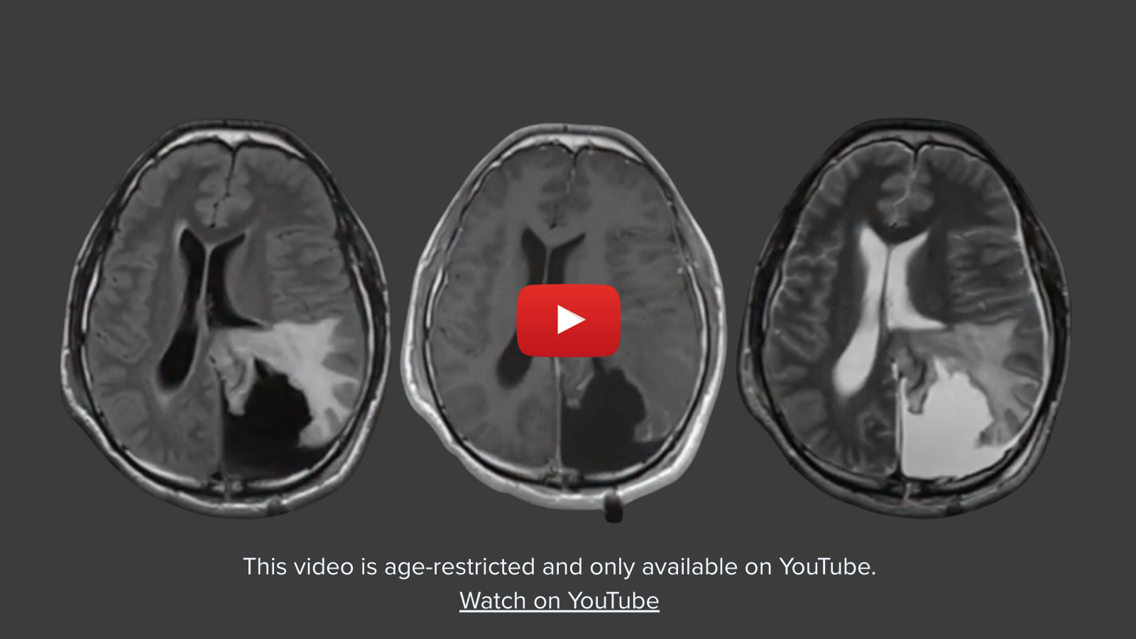 New Jersey Brain and Spine | Fluorescence-Guided Tumor Resection