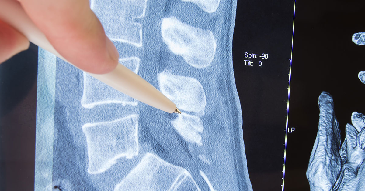 Spine Surgery for Back Pain? - Read A Neurosurgeon's Advice