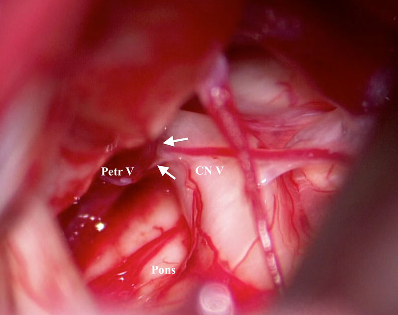 distortion trigeminal nerve - intraoperative view