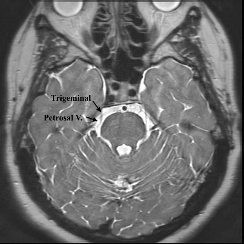 distortion trigeminal nerve - axial view