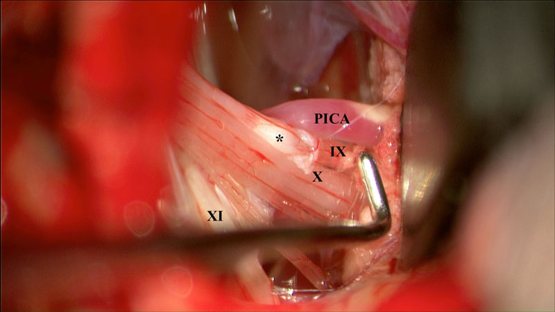 Intraoperative image demonstrating relationship of PICA to glossopharyngeal nerve (CN IX) in Glossopharyngeal Neuralgia