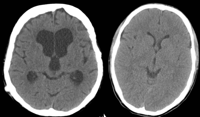 Ultrasound images illustrate the difference between a brain without hydrocephalus and one with a buildup of fluid on the brain. 