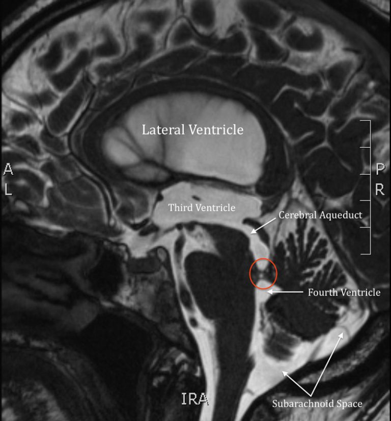 Hydrocephalus 101: Causes, Symptoms, and Treatments in NJ