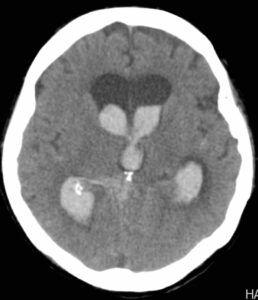 After Intraventricular Hemorrhage