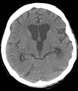 Before Intraventricular Hemorrhage