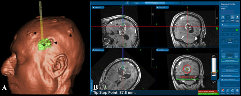 Neuro-Navigation - New Jersey Brain and Spine