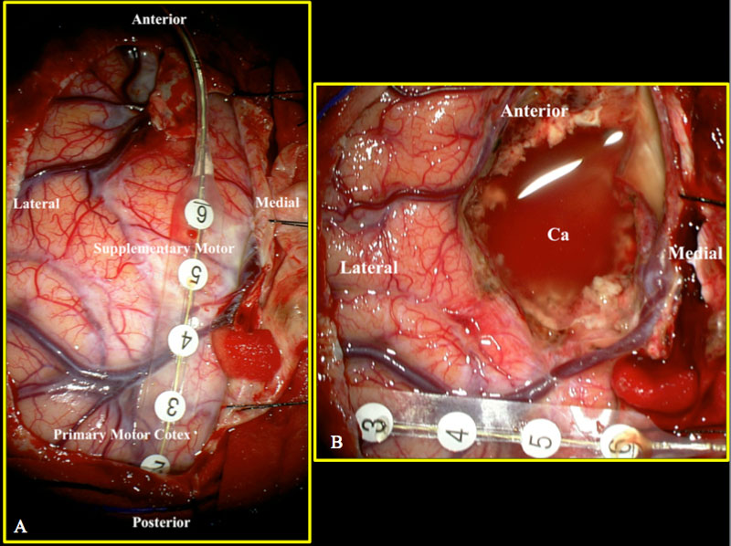 Image A shows an electrode on the brain surface with SSEP phase reversal at the junction of the motor and sensory cortex.