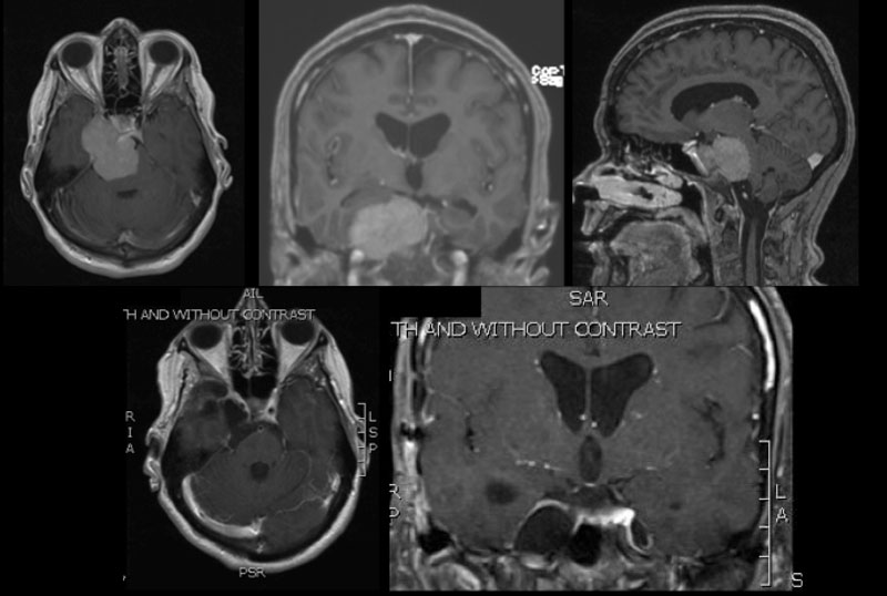 Skull-Base Surgery - New Jersey Brain and Spine