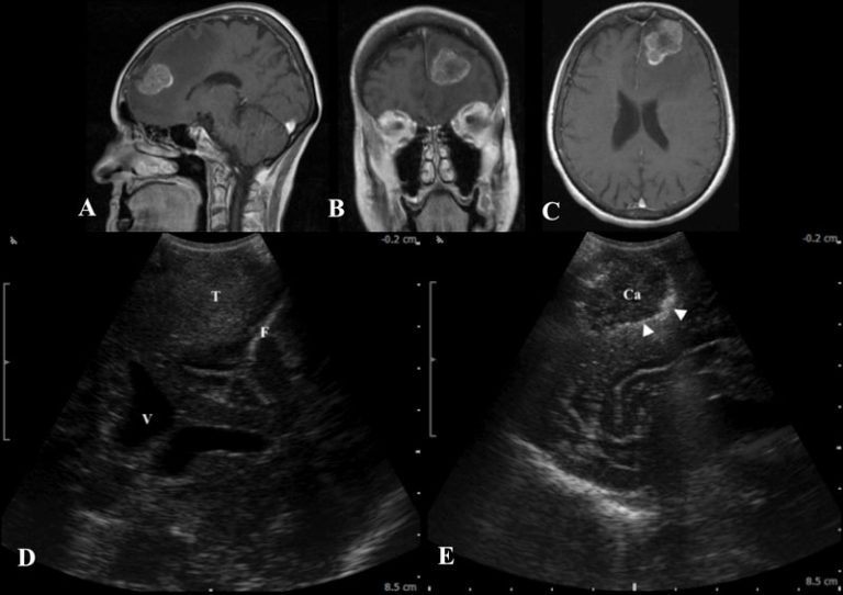 Intraoperative Ultrasound New Jersey Brain and Spine