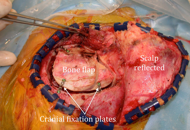 Craniotomy procedure picture - the differences between craniotomy vs craniectomy are discussed here.