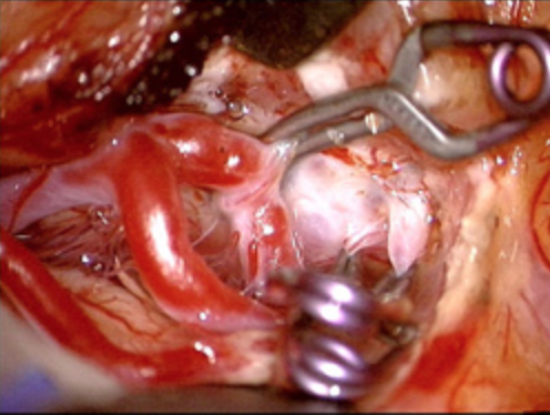 Aneurysm Clips for Neurosurgery