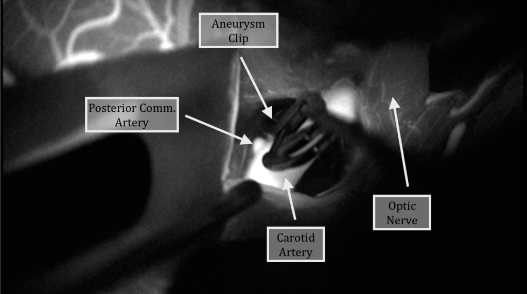 An ultrasound of brain vessels illustrating a craniotomy treatment for aneurysm and a craniotomy vs craniectomy
