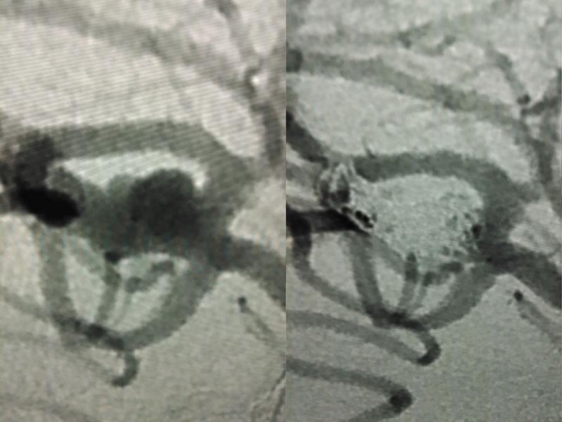 X-ray image demonstrating the use of balloon angioplasty when aneurysm coiling is not viable. 