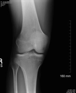 kneecap pain - patella xray