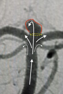 Cerebral angiogram basilar tip brain aneurysm
