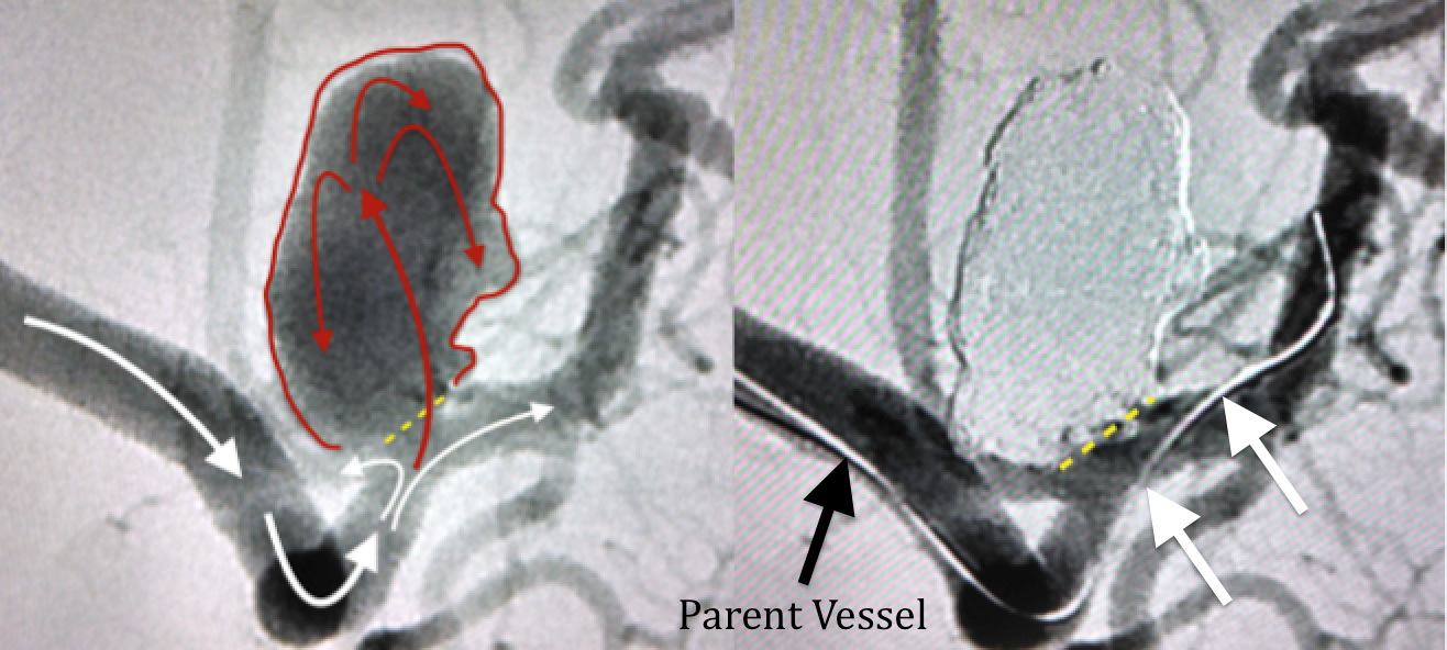 Cerebral angiogram - brain aneurysm