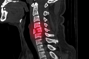 cervical spinal injury xray example