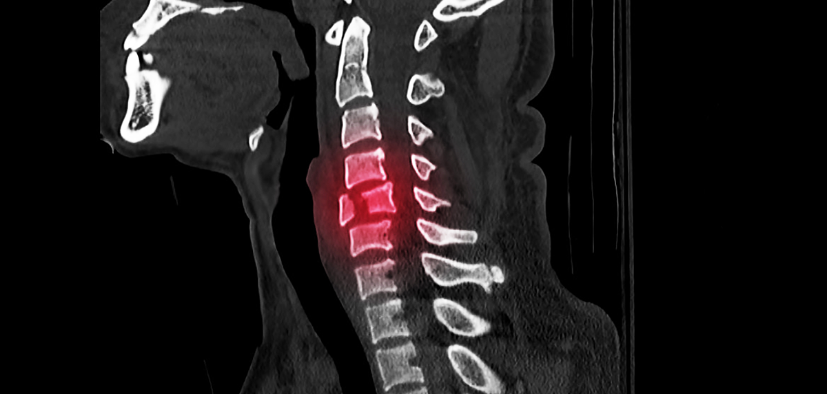 cervical spinal injury xray example