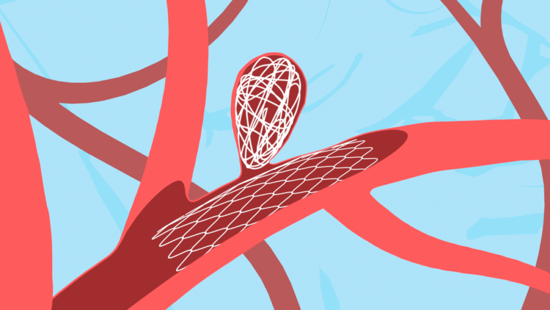 Aneurysm Treatment Options: Clipping vs Coiling Explained