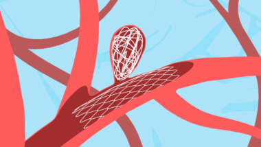 What is a Brain Aneurysm? Unmasking the Silent Threat