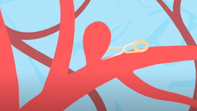New Jersey Brain and Spine | Multidisciplinary Care for Aneurysms and Arteriovenous Malformations (AVMs)