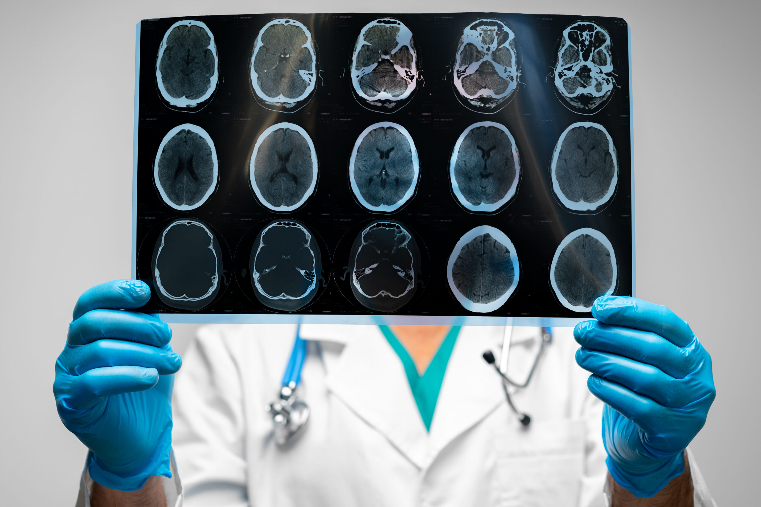 Doctor in blue gloves holding an MRI scan with multiple brain cross-section images.