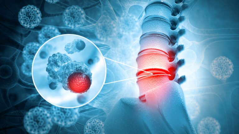 New Jersey Brain and Spine | Understanding the Different Types of Spinal Tumors