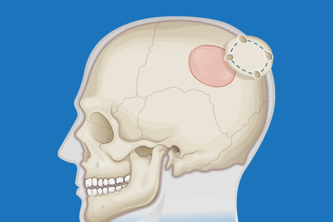 Stryker Router Craniotomy Craniotomy Recovery & Rehabilitation - Know What to Expect