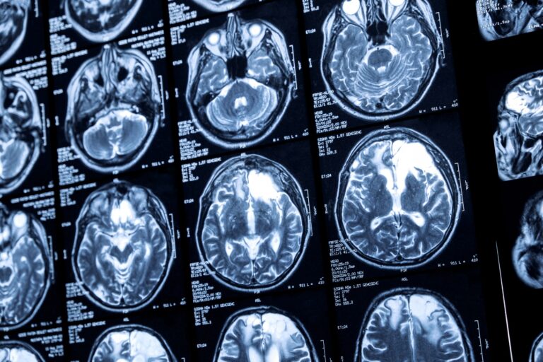 New Jersey Brain and Spine | Recurrent Schwannoma: Management Strategies for Tumor Recurrence