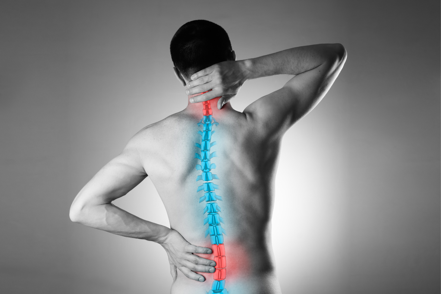 Illustration of adjacent segment disease showing degeneration at spinal levels above and below a lumbar fusion