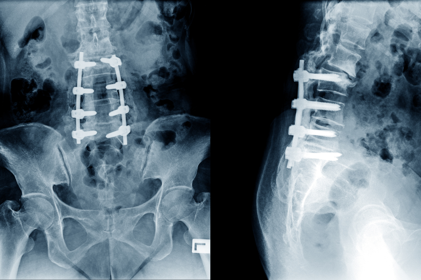 NJBS spine specialist evaluating a patient with persistent postoperative back pain after spinal surgery