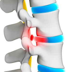 New Jersey Brain and Spine | Sciatica vs. Herniated Disc: How to Tell the Difference and When to See a North Jersey Specialist New Jersey Brain and Spine | Sciatica vs. Herniated Disc: How to Tell the Difference and When to See a North Jersey Specialist