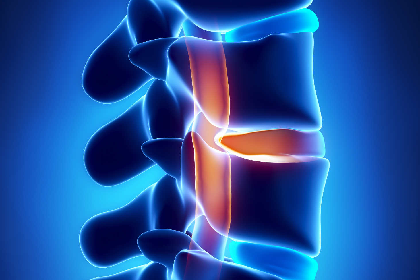 Lumbar spinal stenosis causing neurogenic claudication and leg pain, treated with minimally invasive surgery at NJBS