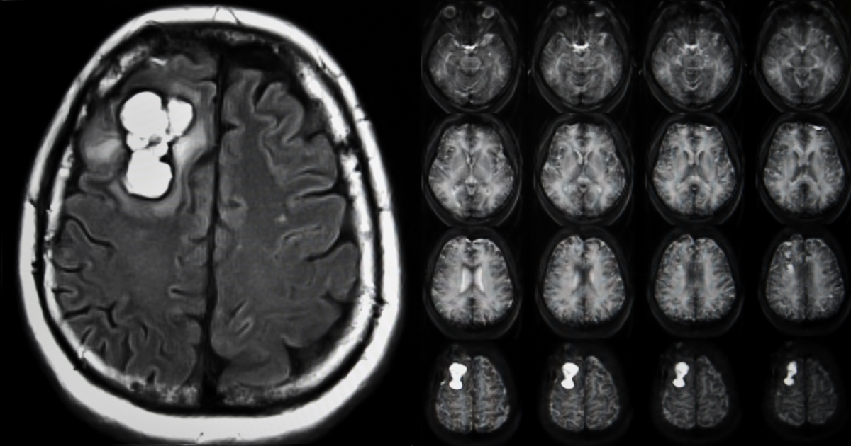 How a brain tumor's location determines symptoms and treatment, New Jersey Brain and Spine