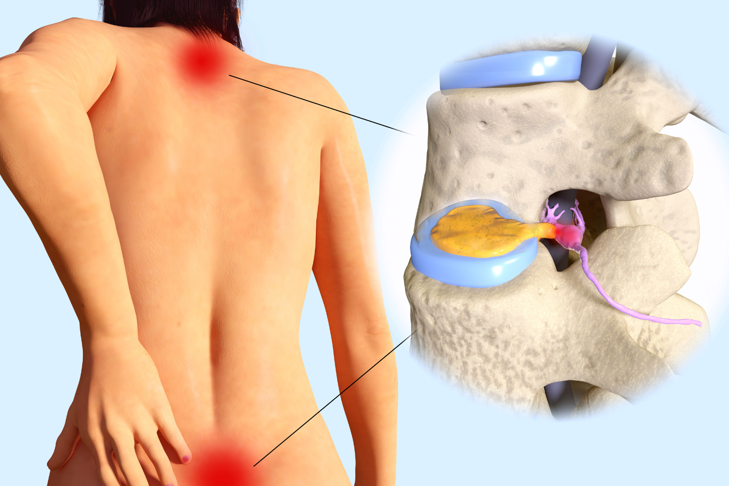 Disc herniation versus disc bulge explained by New Jersey Brain and Spine neurosurgeons