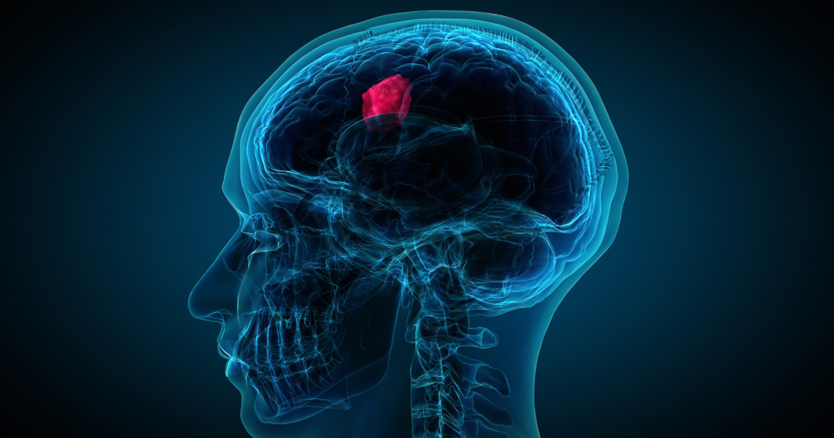Understanding when brain tumor surgery is necessary at New Jersey Brain and Spine