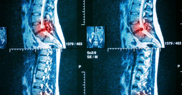 Why MRI findings do not always match spine symptoms, explained by New Jersey Brain and Spine