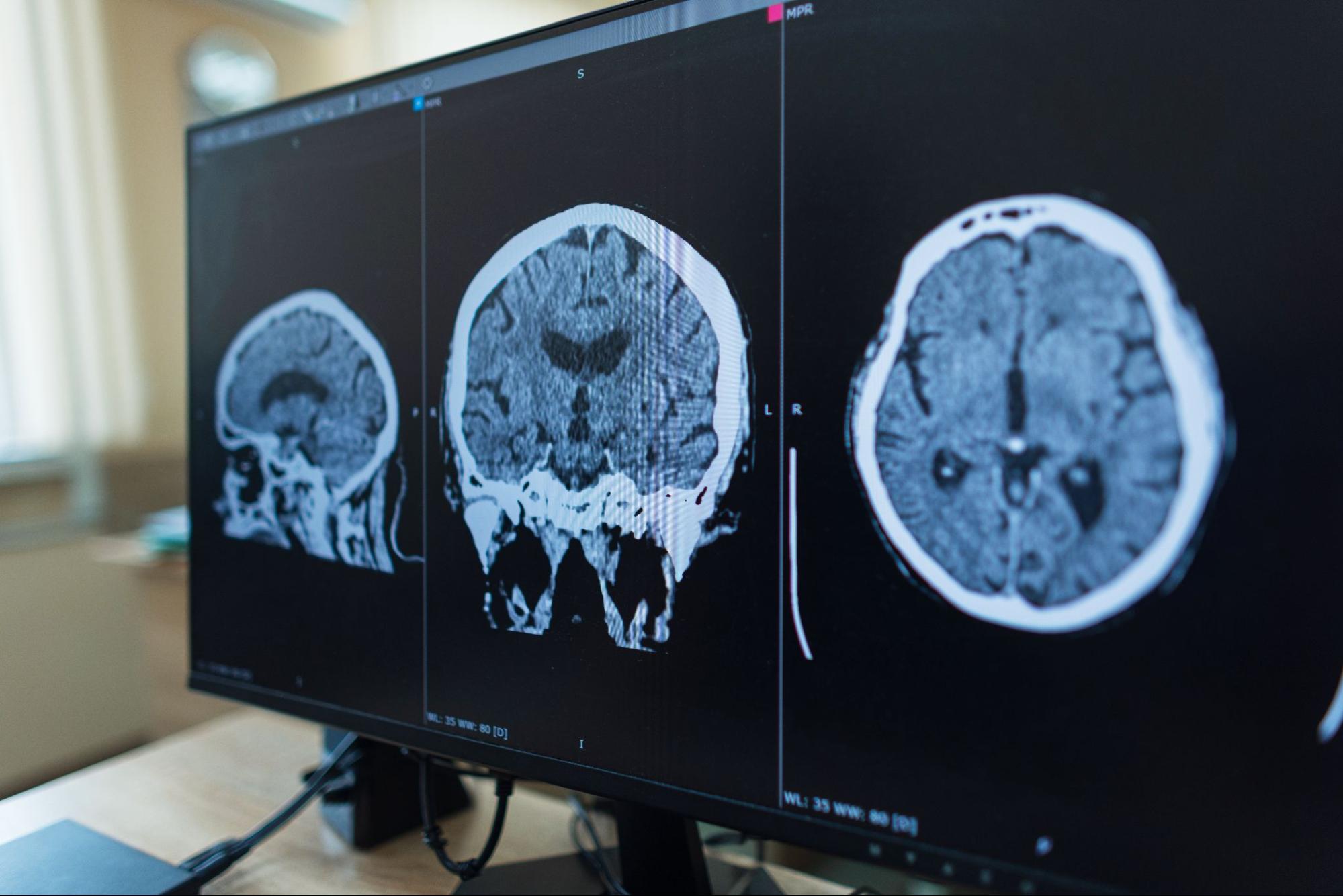 benign_vs_malignant_brain_tumors_how_growth_pattern_drives_treatment Brain MRI scan used to evaluate benign and malignant brain tumors - New Jersey Brain and Spine