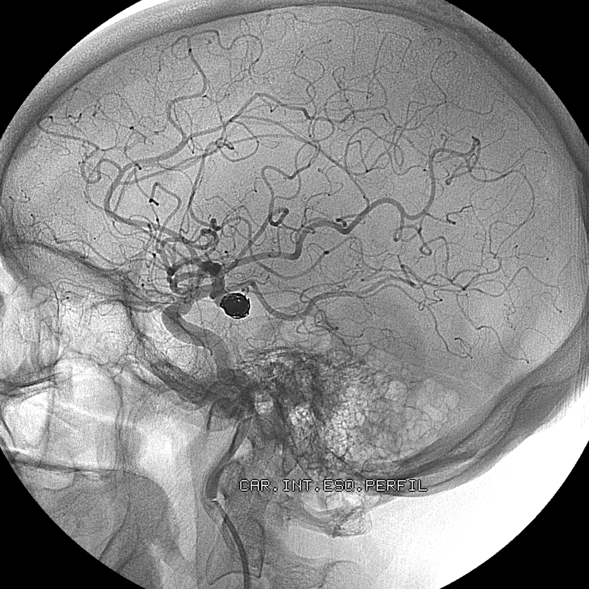 Cerebral angiogram showing a brain aneurysm, illustrating genetic and family history risk factors, New Jersey Brain and Spine