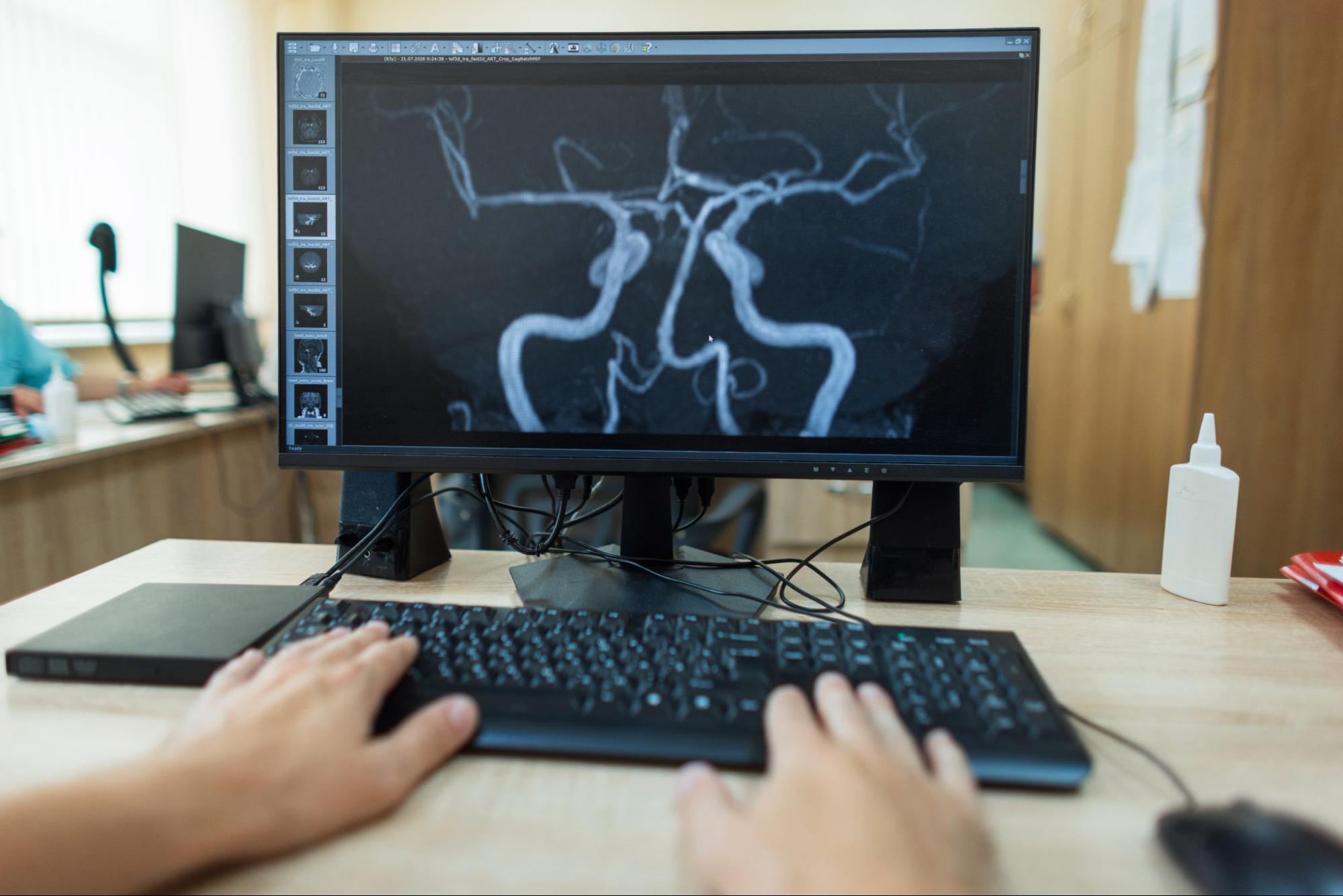 Cerebral angiogram showing brain blood vessels used to evaluate aneurysms - New Jersey Brain and Spine