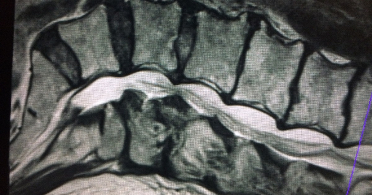 my-mri-shows-lumbar-stenosis-do-i-need-surgery MRI showing lumbar spinal stenosis, New Jersey Brain and Spine