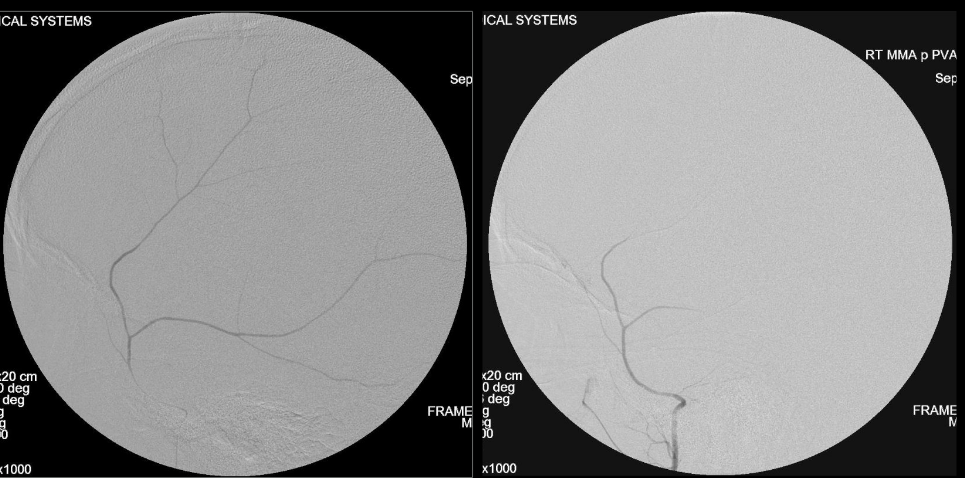 Angiogram images of middle meningeal artery embolization with Onyx 12 at New Jersey Brain and Spine